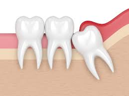 Wisdom Teeth Removal Katy, TX