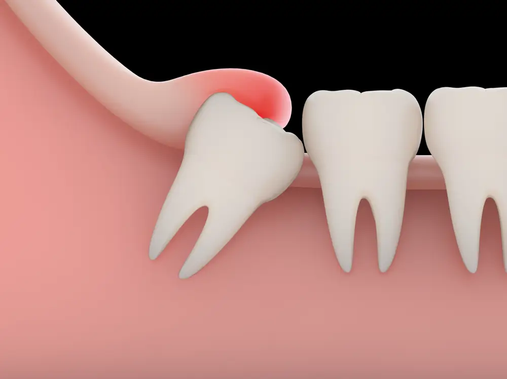 Wisdom Teeth Removal Katy, TX | Wisdom Teeth Factory