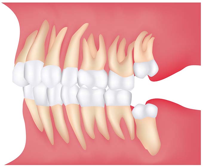 Wisdom Teeth Removal Spring, TX | Wisdom Teeth Factory