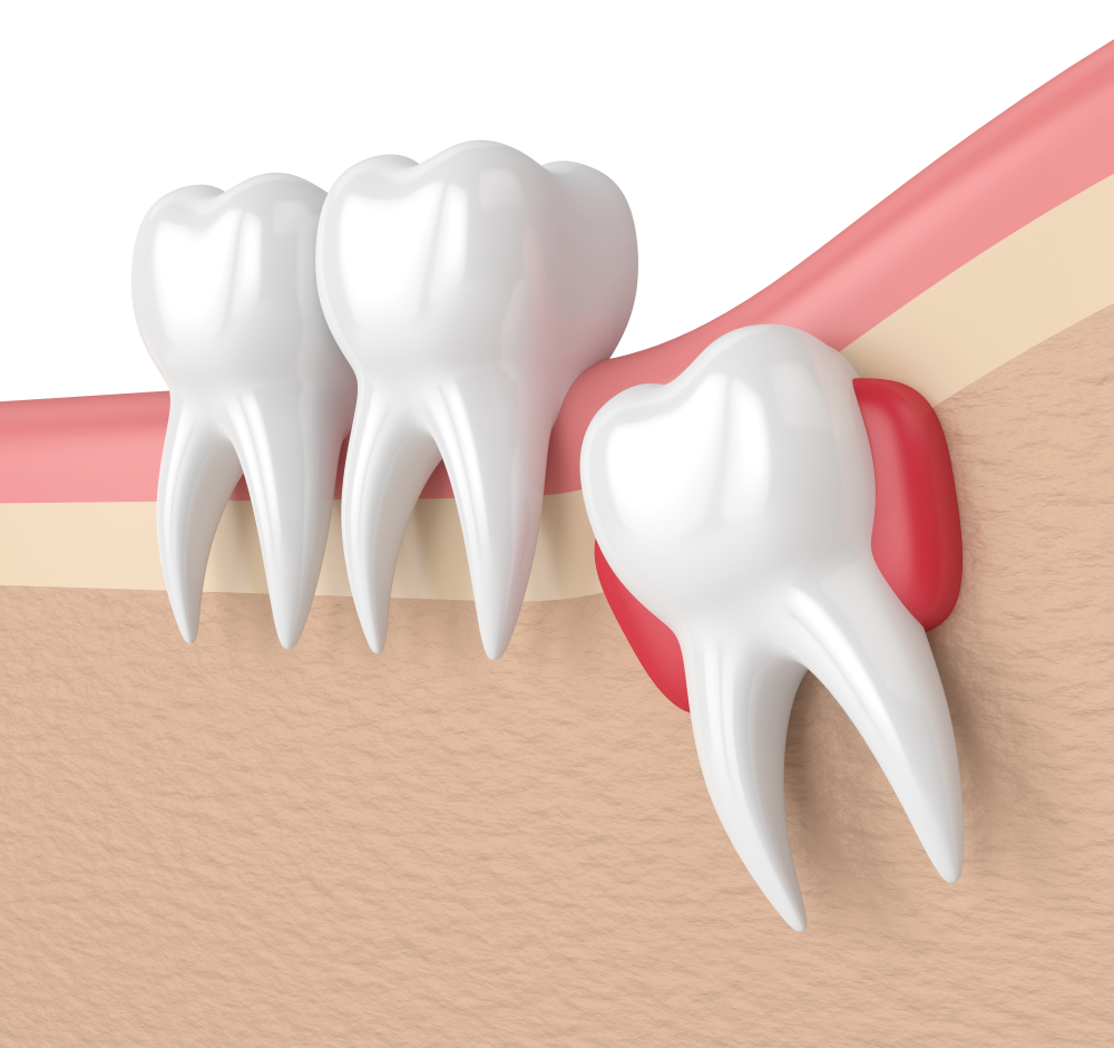 Wisdom Teeth Removal Richmond, TX | Wisdom Teeth Factory