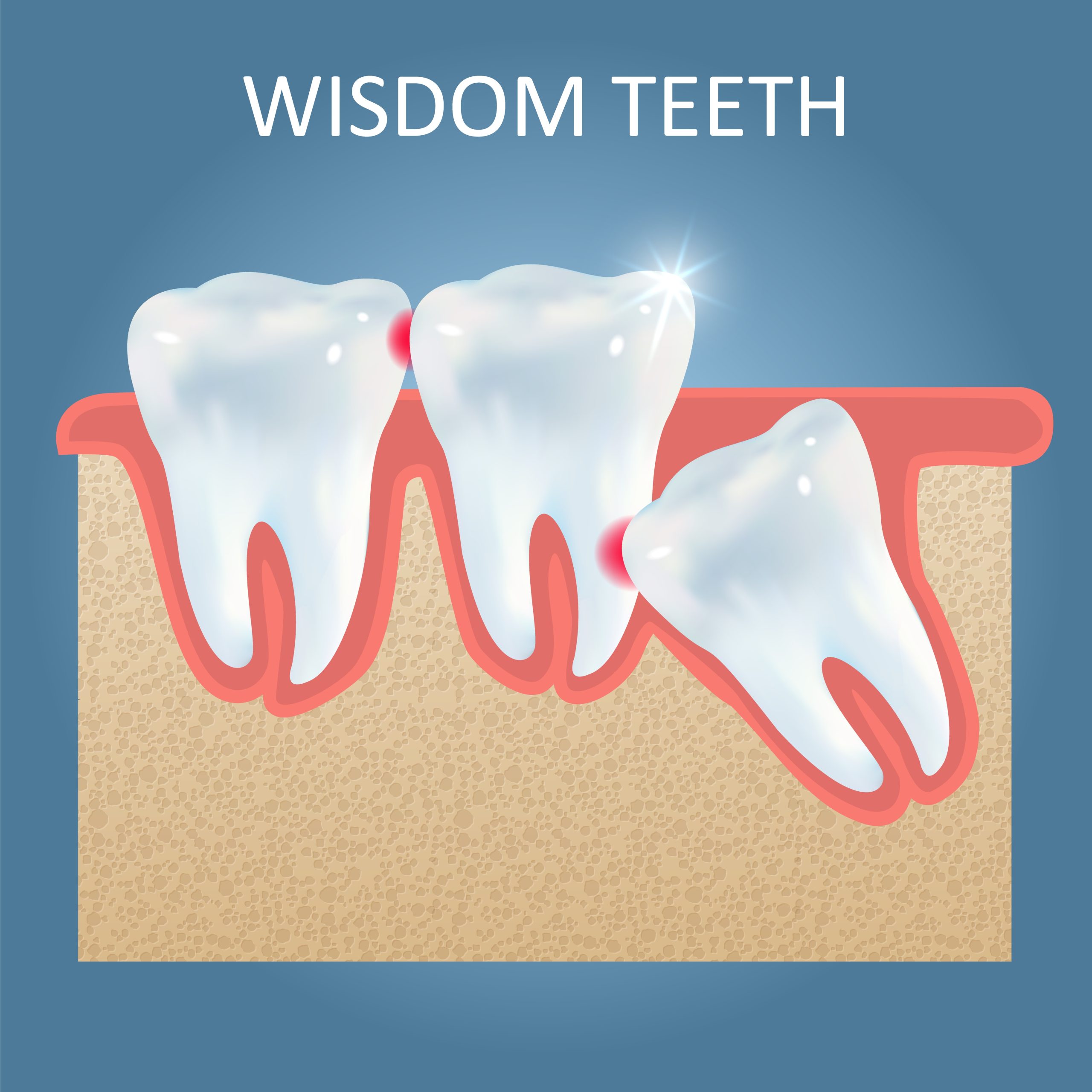 Wisdom Teeth Removal Katy, TX | Wisdom Teeth Factory