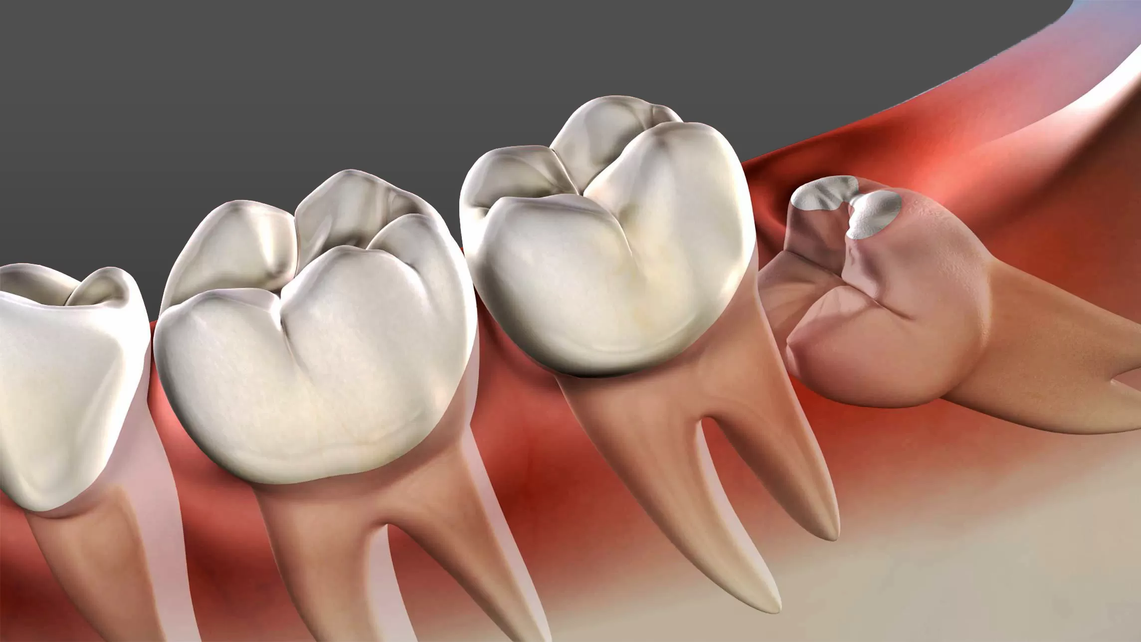 Wisdom Teeth Removal Richmond, TX | Wisdom Teeth Factory