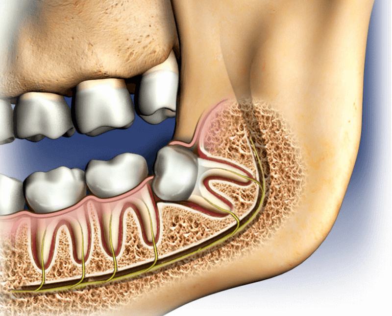 Wisdom Teeth Removal Cypress, TX | Wisdom Teeth Factory