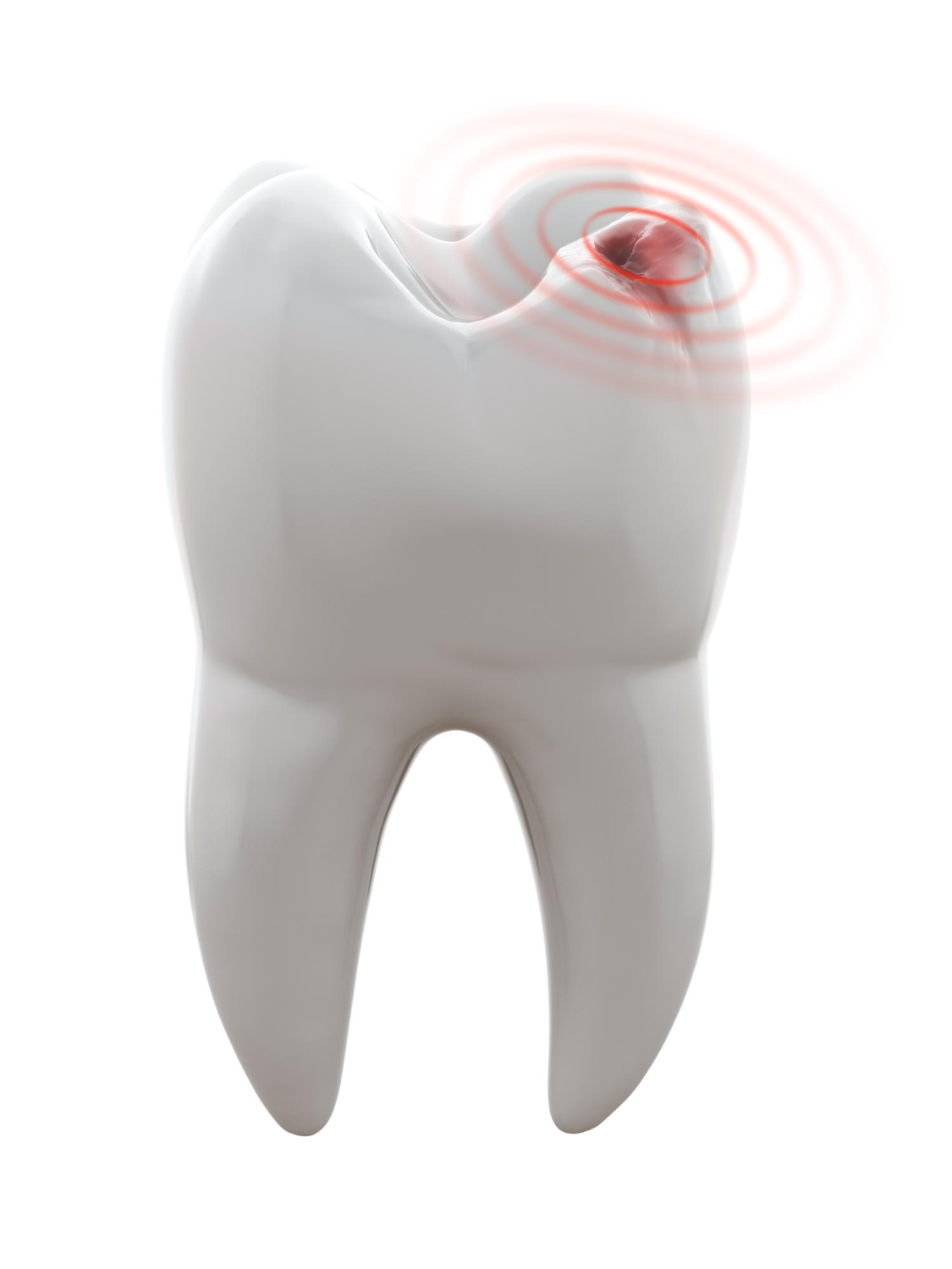 Wisdom Teeth Removal Katy, TX | Wisdom Teeth Factory