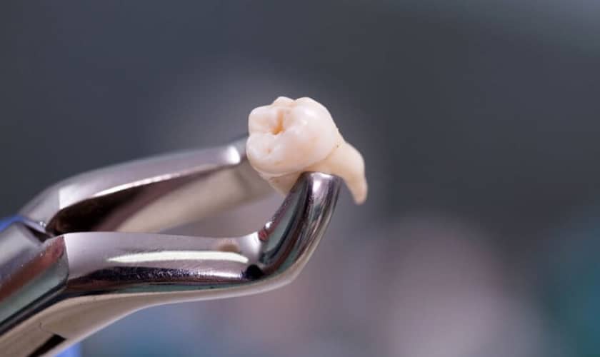 Wisdom Teeth Removal Cypress, TX | Wisdom Teeth Factory