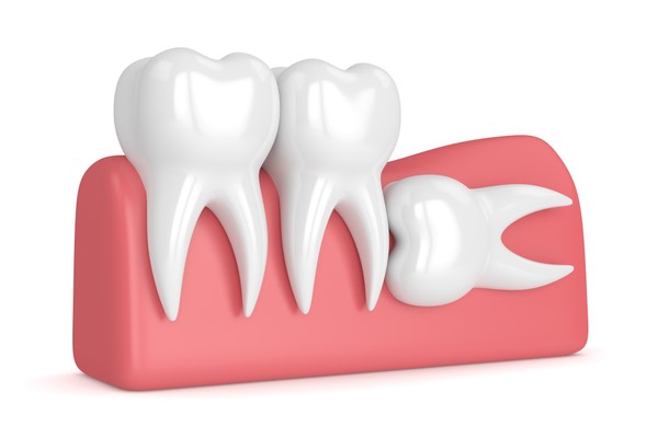 What Are Wisdom Teeth? | Wisdom Teeth Factory