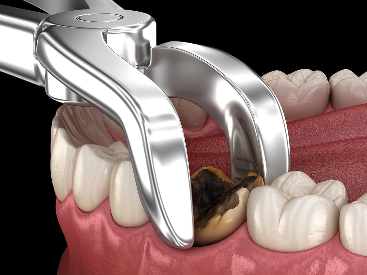 Wisdom Teeth Removal Surgery | Wisdom Teeth Factory