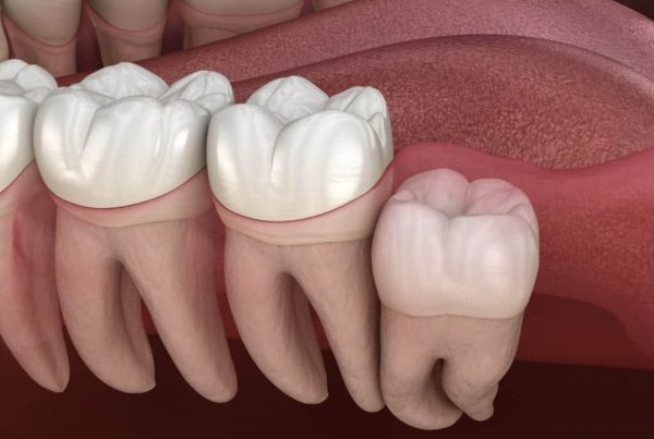 Wisdom Teeth Remove Recovery Timeline | Wisdom Teeth Factory