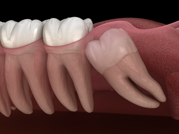 Wisdom Teeth Removal Surgery | Wisdom Teeth Factory