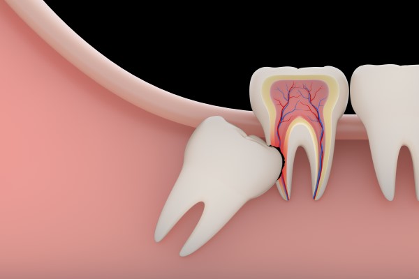 Wisdom Teeth Removal Surgery | Wisdom Teeth Factory