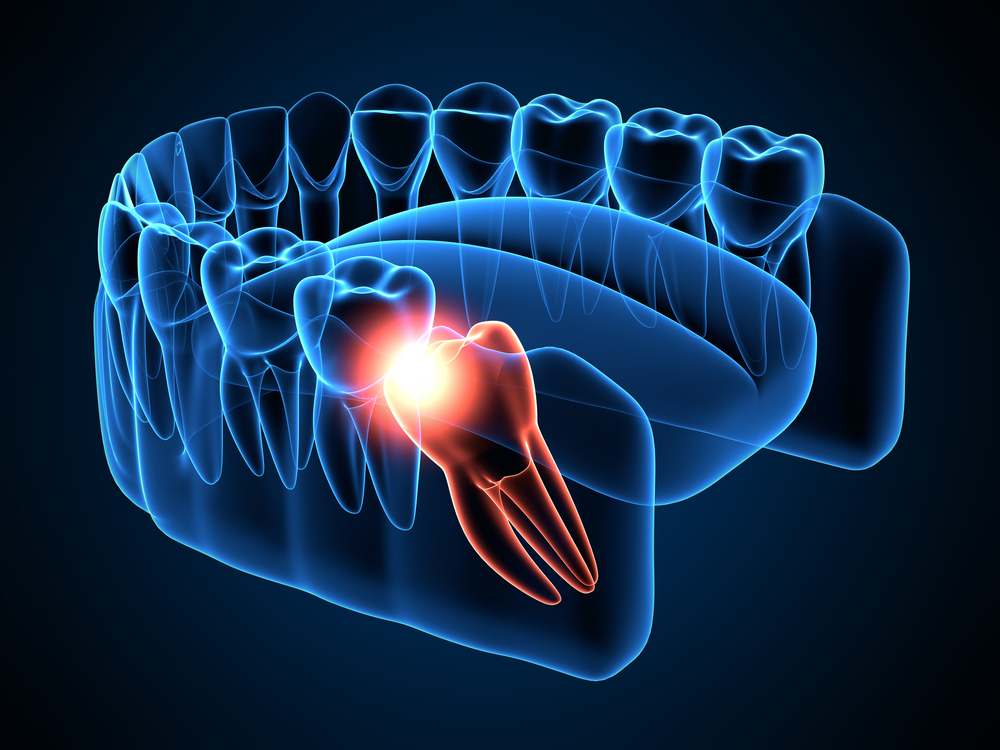 Wisdom Teeth Removal Aftercare | Wisdom Teeth Factory