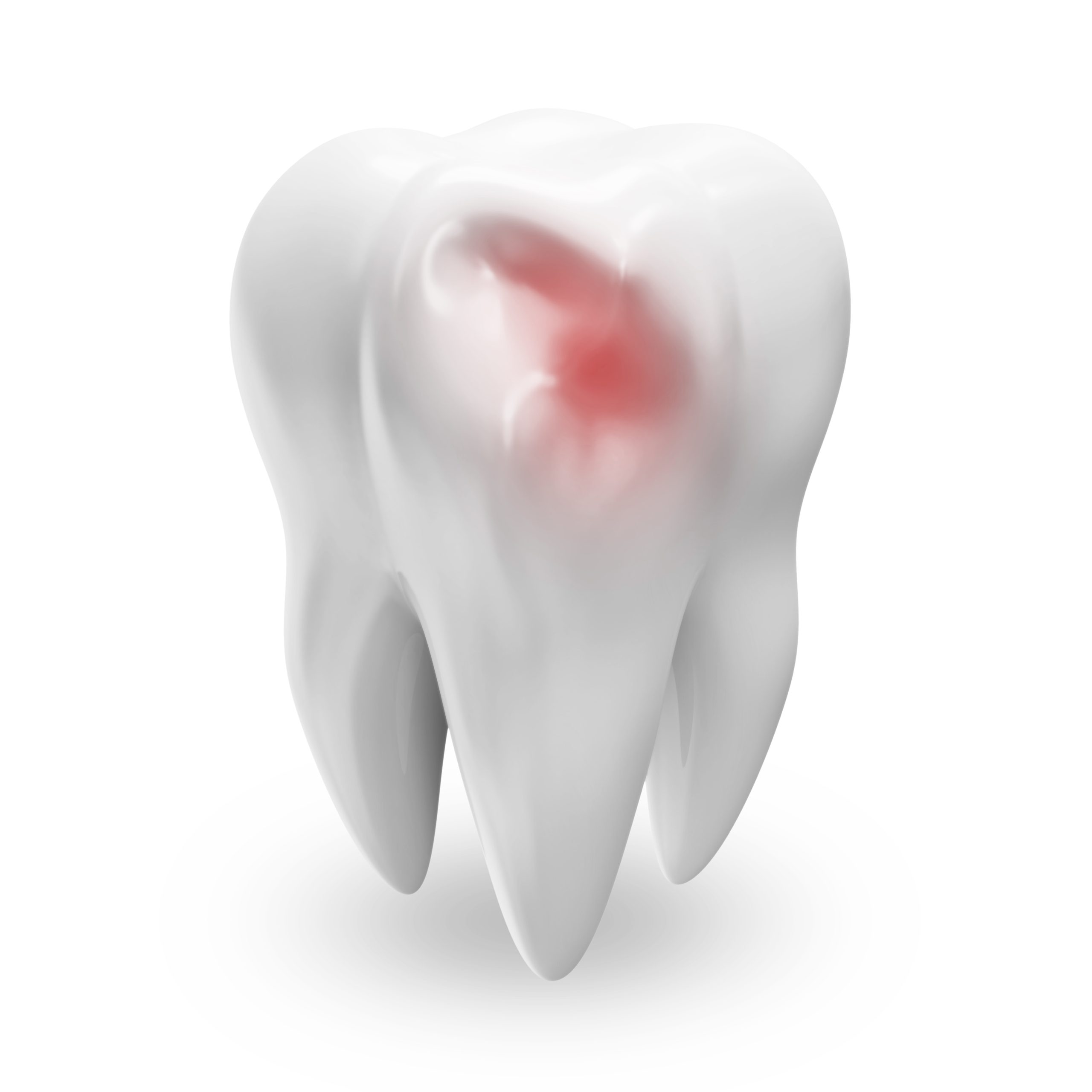 wisdom tooth nerve exposure | Wisdom Teeth Factory