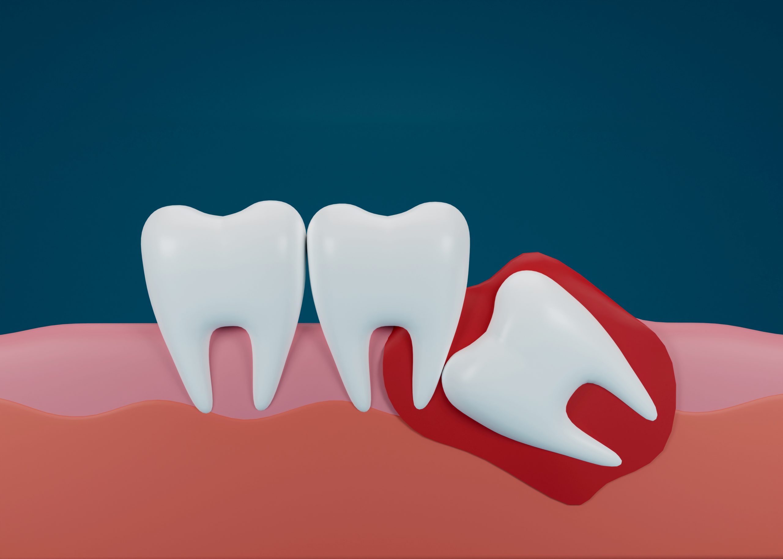 Wisdom Teeth Removal Financing Houston | Wisdom Teeth Factory